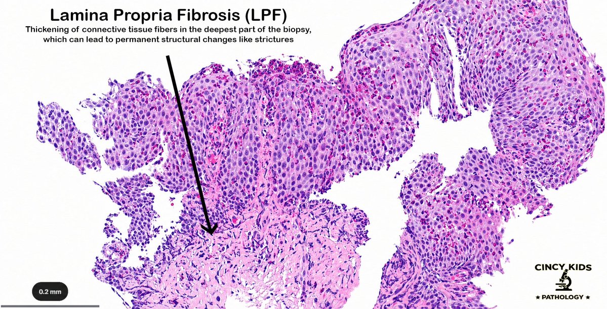 CincyKidsPath's tweet image. Counting eos is not enough 🔍

15 eos/hpf supports EoE, but EoE-HSS captures true disease activity by scoring 8 histologic features. 
See for yourself: cchmc.pathpresenter.net/public/display…
#PediPath #GIpath #EoE #MedEd