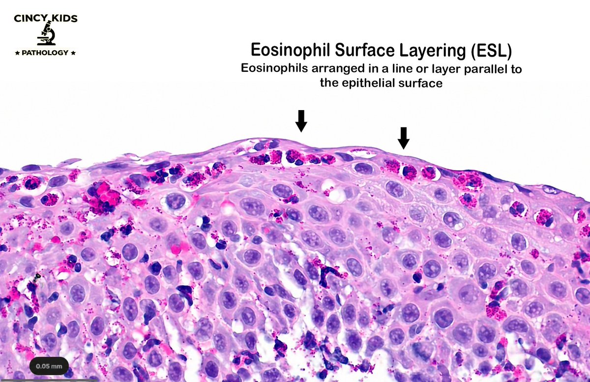 CincyKidsPath's tweet image. Counting eos is not enough 🔍

15 eos/hpf supports EoE, but EoE-HSS captures true disease activity by scoring 8 histologic features. 
See for yourself: cchmc.pathpresenter.net/public/display…
#PediPath #GIpath #EoE #MedEd