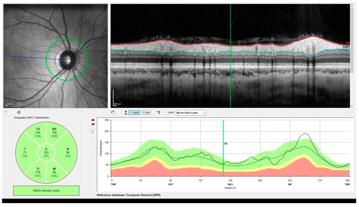 neurolint_mdpi's tweet image. Welcome to read the review paper: 

Optical Coherence Tomography in Huntington's Disease—A Potential Future Biomarker for Neurodegeneration? by Clancy Cerejo et al. 

Full-text Available: mdpi.com/3141576

#Huntington #opticalcoherencetomography #neurodegeneration