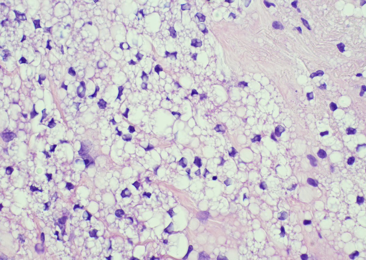 SandraIxchelS's tweet image. Bubbly silicone! 

#breastpathology #breast
