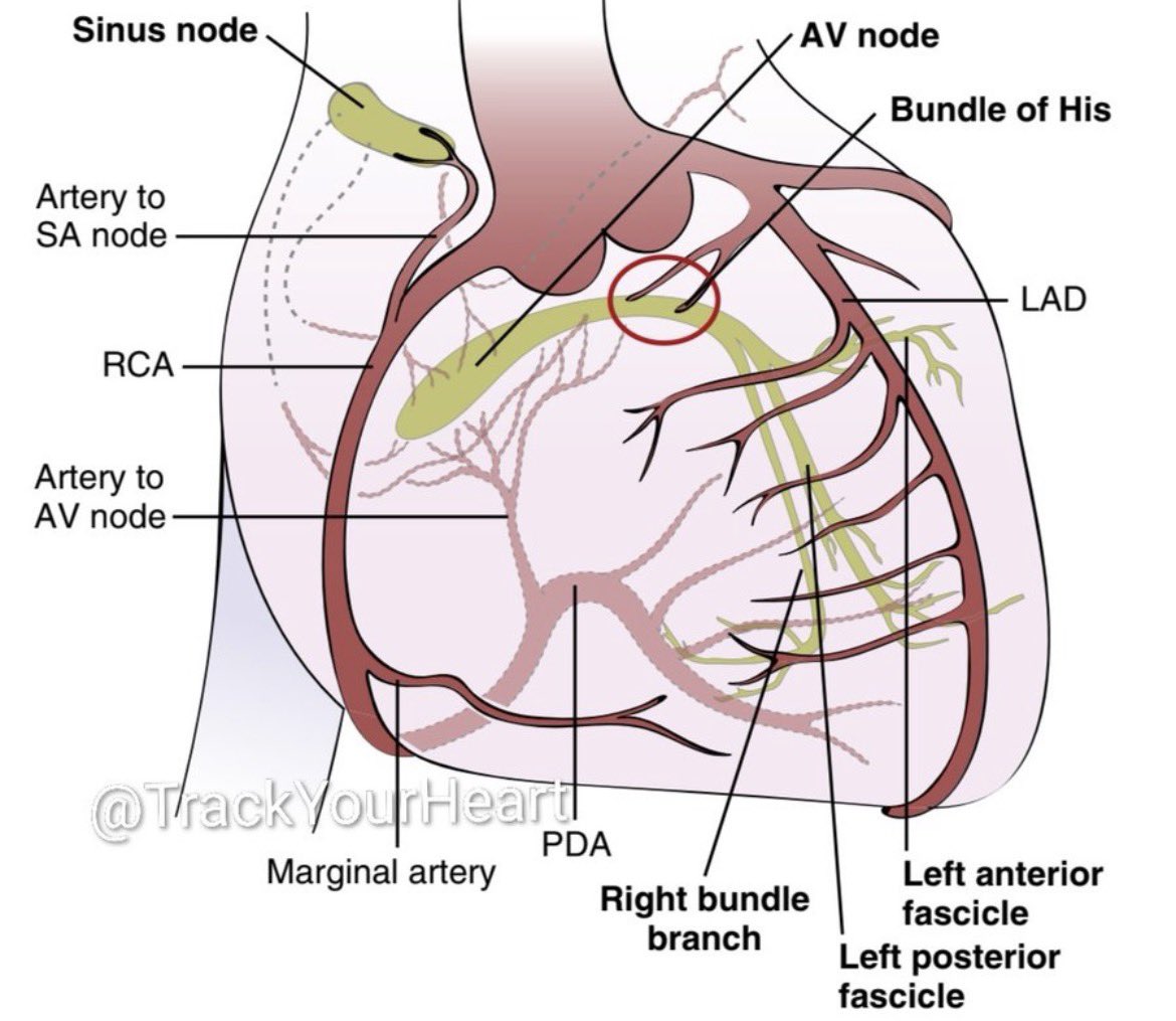 ZainKhalpey's tweet image. The conduction system follows the blood supply. 

When perfusion changes, the ECG usually tells the story.

@TrackYourHeart 

#MedTwitter #Cardiology #ECG #Electrophysiology