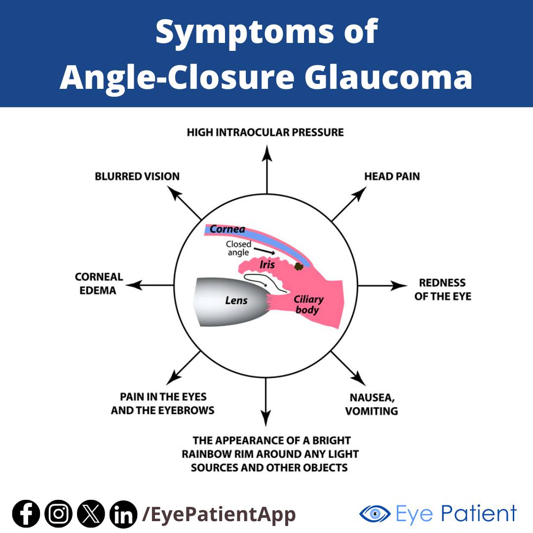 EyePatientApp's tweet image. Symptoms of Angle-Closure Glaucoma | #Free Eye Patient App To learn more about your eyes, monitor your vision, and find an eye doctor near you download the Eye Patient app (available on Android &amp;amp; iOS): onelink.to/eyepatientapp
#eyes #ophthalmology #optometry #diabetescare #retina