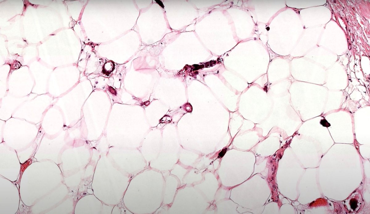 JMGardnerMD's tweet image. 45 F on dialysis. Enlarging very painful black eschar/ulcer on abdomen. 
Answer ✅ youtu.be/Xszx4mUDTmk 
Video (101): youtu.be/fESY7haH18U 
#pathology #pathologists #pathTwitter #dermpath #dermatology #dermatologia #dermtwitter