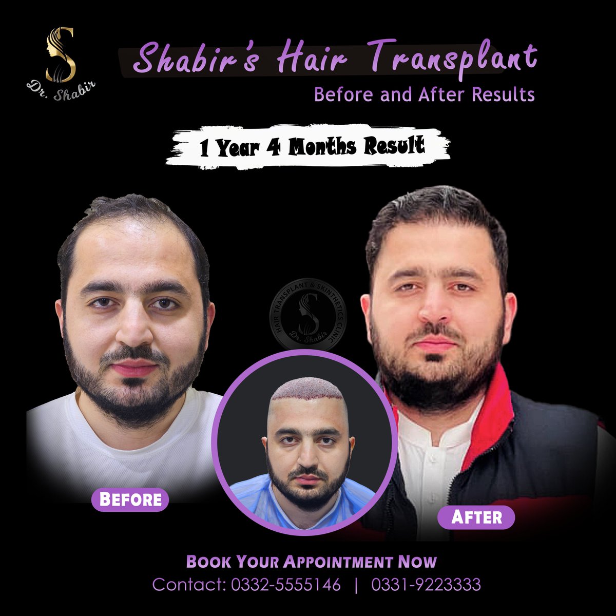 drshabirhts's tweet image. 𝐍𝐚𝐭𝐮𝐫𝐚𝐥 𝐋𝐨𝐨𝐤, 𝐌𝐚𝐱𝐢𝐦𝐮𝐦 𝐃𝐞𝐧𝐬𝐢𝐭𝐲 𝐨𝐧𝐥𝐲 𝐰𝐢𝐭𝐡 𝐃𝐫 𝐒𝐡𝐚𝐛𝐢𝐫 𝐇𝐚𝐢𝐫 𝐓𝐫𝐚𝐧𝐬𝐩𝐥𝐚𝐧𝐭 𝐂𝐥𝐢𝐧𝐢𝐜..

📷 Book your consultation today!
📷 𝐖𝐡𝐚𝐭𝐬𝐀𝐩𝐩:
📷 0332 5555146
 #peshawar  #drshabirclinic  #HairClinic  #HairGrowth #NaturalHair