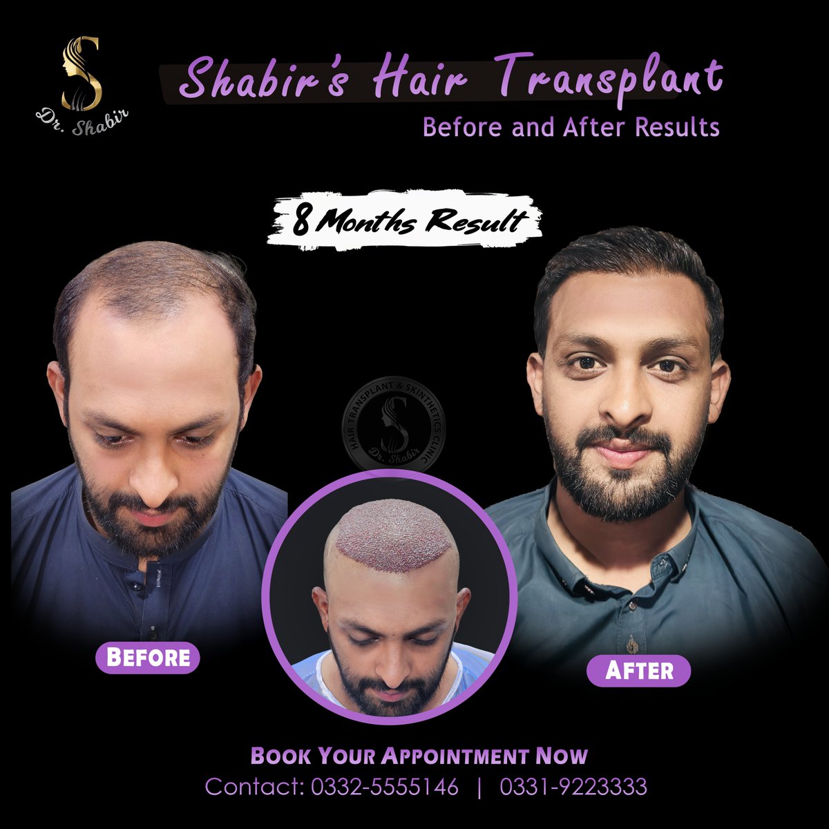 drshabirhts's tweet image. 𝐍𝐚𝐭𝐮𝐫𝐚𝐥 𝐋𝐨𝐨𝐤, 𝐌𝐚𝐱𝐢𝐦𝐮𝐦 𝐃𝐞𝐧𝐬𝐢𝐭𝐲 𝐨𝐧𝐥𝐲 𝐰𝐢𝐭𝐡 𝐃𝐫 𝐒𝐡𝐚𝐛𝐢𝐫 𝐇𝐚𝐢𝐫 𝐓𝐫𝐚𝐧𝐬𝐩𝐥𝐚𝐧𝐭 𝐂𝐥𝐢𝐧𝐢𝐜..

📷 Book your consultation today!
📷 𝐖𝐡𝐚𝐭𝐬𝐀𝐩𝐩:
📷 0332 5555146
 #peshawar  #drshabirclinic  #HairClinic  #HairGrowth #NaturalHair