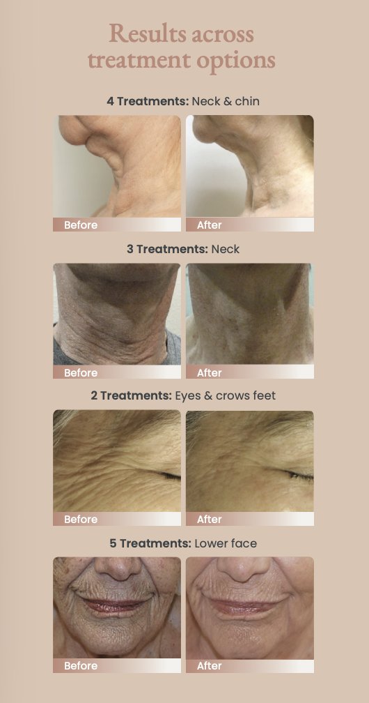 MagnifiqueLaser's tweet photo. We’ve seen real tightening over 6–12 weeks with radiofrequency: firmer jawlines, smoother texture, and better laxity. Treatments are protocol-driven and supervised in-clinic for  results. Sessions are comfortable with minimal downtime — you can return to your routine right away! https://t.co/gMsBCeR30J