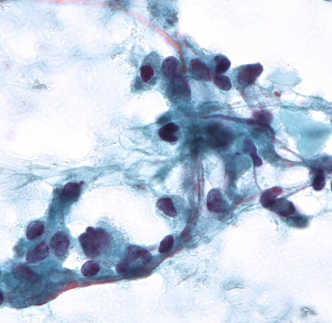 DrCycloPath's tweet image. #PathQuiz 🔬🦋 #EndocrinePath

_____________ thyroid carcinoma
A) Papillary  
B) Anaplastic  
C) Follicular  
D) Medullary  

#Pathology #EndocrinePath #Thyroid