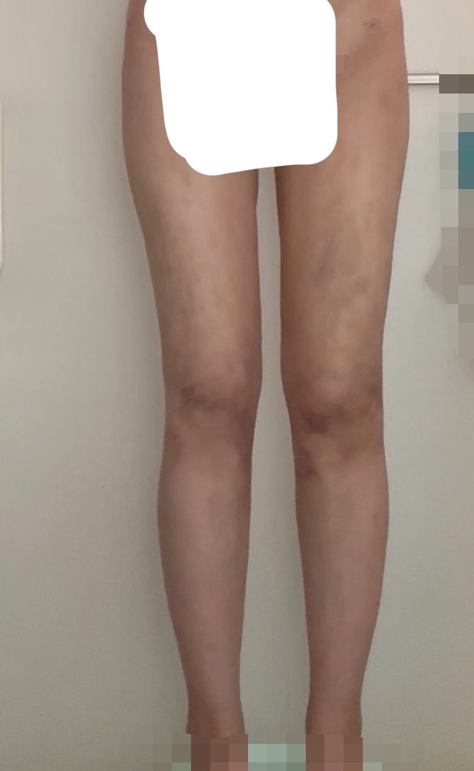 いがいがうに　太もも脂肪吸引dt tweet media