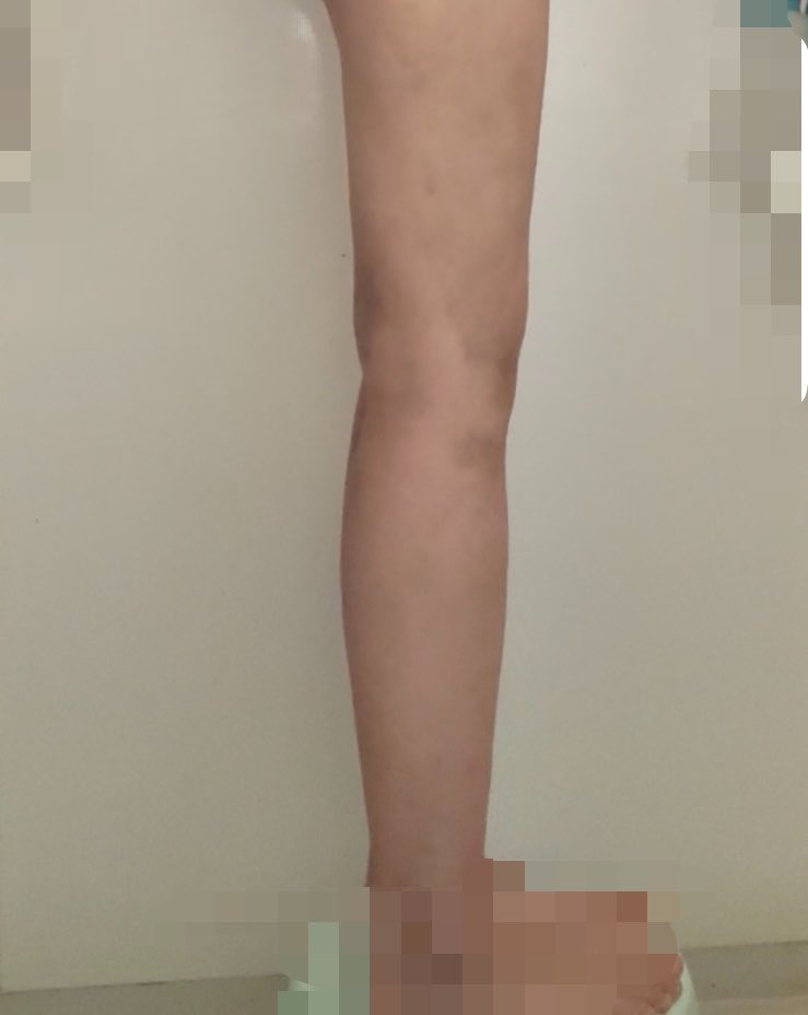 いがいがうに　太もも脂肪吸引dt tweet media