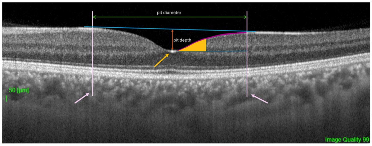 vision_mdpi's tweet image. 👁️ Foveal aging: it’s not your biological age
Study in healthy adults: foveal pit stays stable, but foveal bulge fades with age
Chronological age = enough; no extra info from bio-age
#OCT #RetinalAging #Optometry
📎mdpi.com/3753850