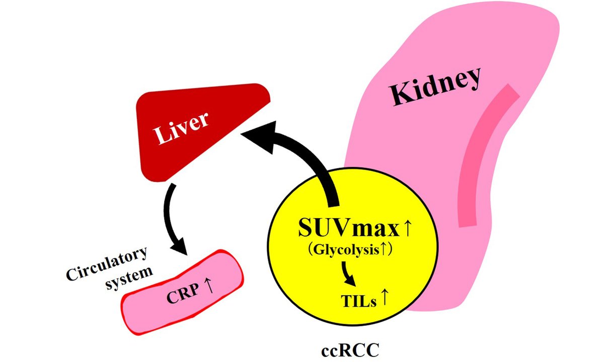 OAE_JCMT's tweet image. 🧬 The application value of preoperative F-FDG PET/CT in localized clear cell renal cell carcinoma

🔗 DOI: 10.20517/2394-4722.2024.103
🌐 oaepublish.com/articles/2394-…

#RenalCellCarcinoma #ccRCC #MedicalImaging #PETCT #CancerResearch #Oncology #Biomarkers #PrecisionMedicine #JCMT