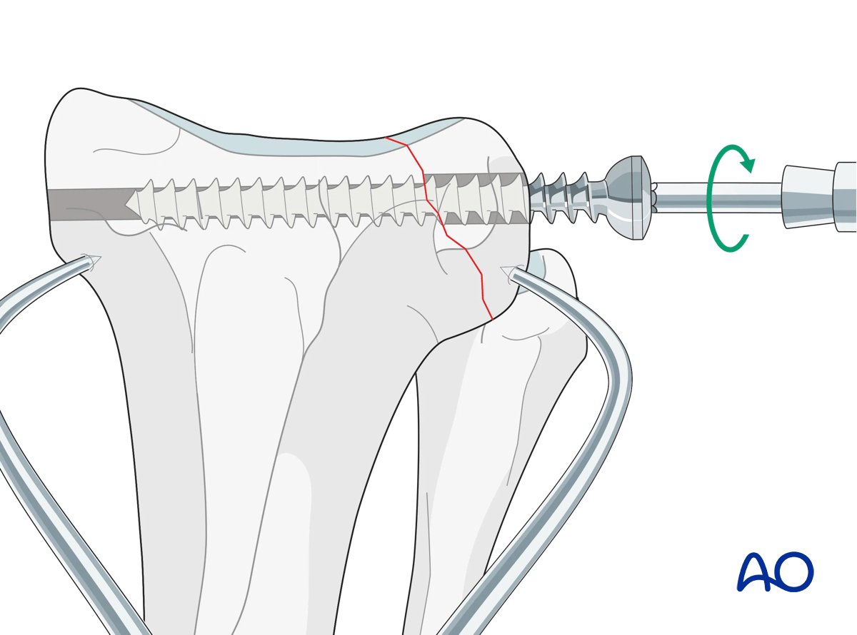 AOSurgery's tweet photo. 🐱 New AO Surgery Reference module released – Cat proximal tibia fractures 🦴

👉 AO VET members can access the module via the AO Surgery Reference platform.
https://t.co/8OmMhohEVm

#AOSurgeryReference #AOVET #VeterinaryOrthopedics #CatFractures #ProximalTibia #VetSurgery 🐾 https://t.co/5dzG9NFw5r