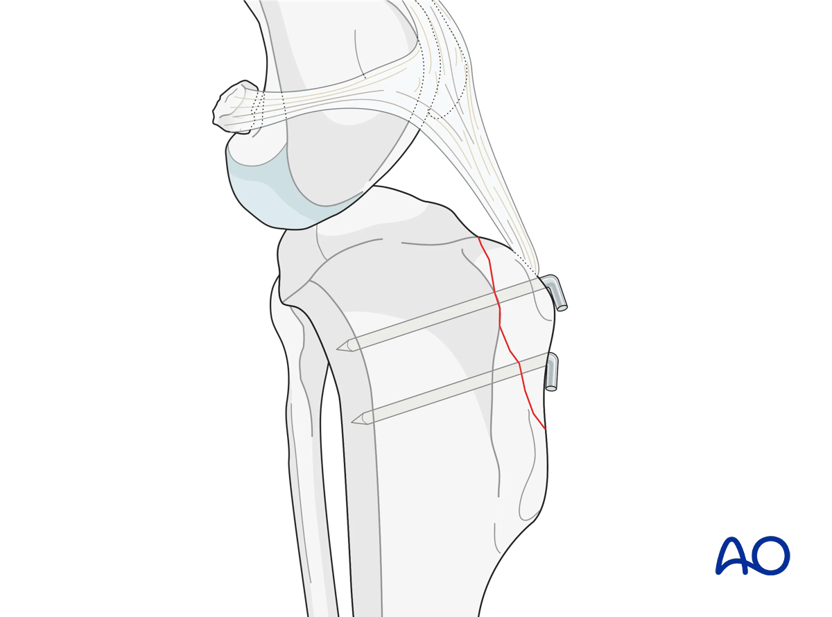 AOSurgery's tweet photo. 🐱 New AO Surgery Reference module released – Cat proximal tibia fractures 🦴

👉 AO VET members can access the module via the AO Surgery Reference platform.
https://t.co/8OmMhohEVm

#AOSurgeryReference #AOVET #VeterinaryOrthopedics #CatFractures #ProximalTibia #VetSurgery 🐾 https://t.co/5dzG9NFw5r