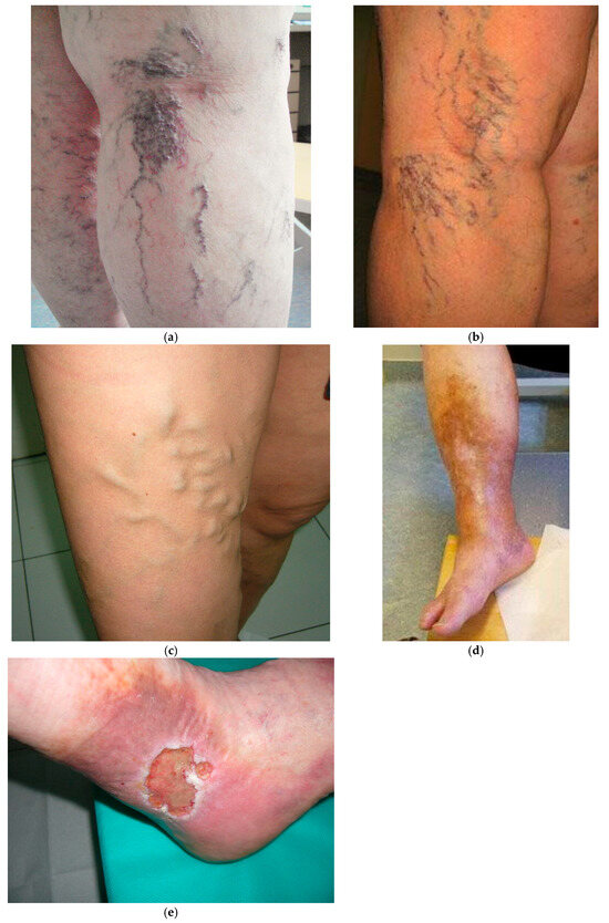 JVDMDPI's tweet image. 📣Welcome to read "Role of #Compression and Physical #Therapy in the #Treatment of #Chronic #Venous #Insufficiency" authored by Lara Vasari et. al 

#CVI #oedema #venous #lower #extremity #exercise #lifestyle #blood

🔗Read more: brnw.ch/21x1MKw