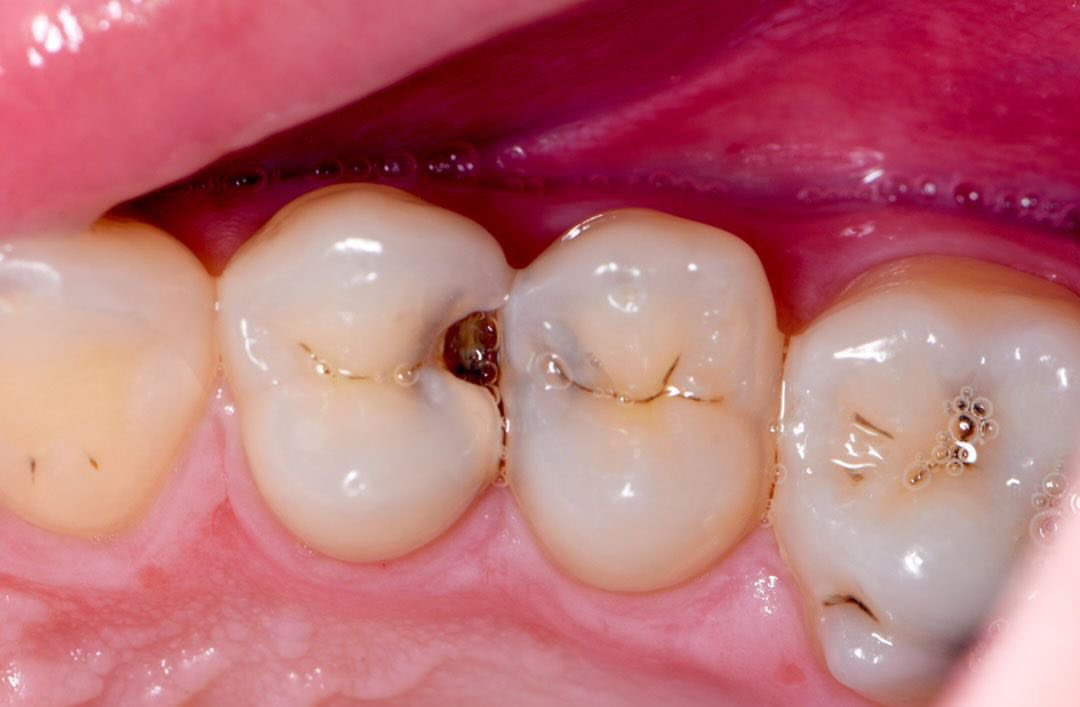 adishuuu's tweet image. haloo! adakah yang punya gigi belakang yang berlubang dalam seperti pada gambar dan mau dilakukan perawatan?

atau ada yang sudah dilakukan perawatan saluran akar dan mau dibuatkan tambalan tetap?

perawatannya gratis yaa! daerah jakpus! 
boleh dm akuu😃
#tambalgigi #psa #gratis