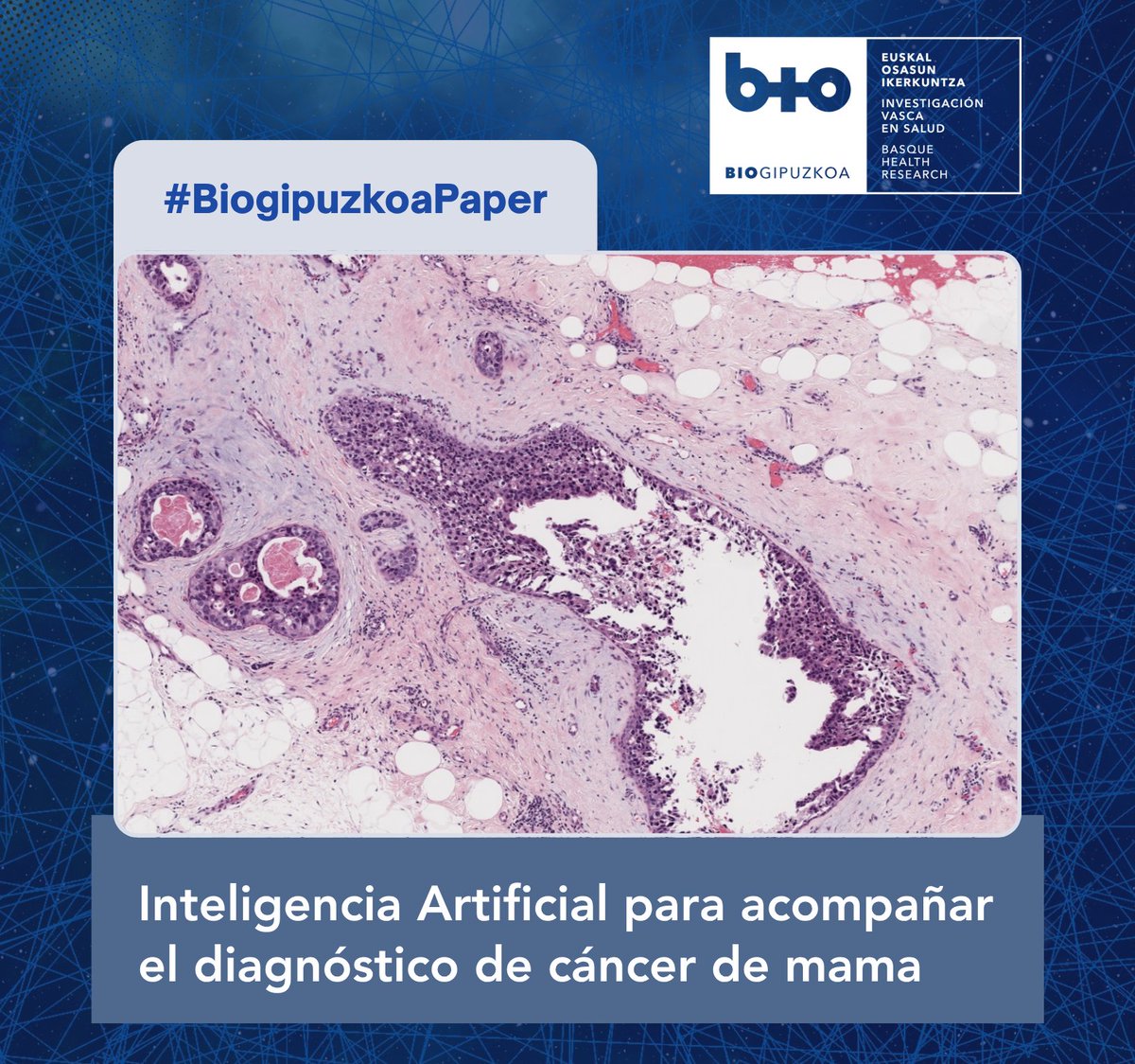 biogipuzkoa's tweet photo. 🔬 Innovación en apoyo al diagnóstico del cáncer de mama
El grupo #eSalud de #Biogipuzkoa con #Vicomtech, ha desarrollado #AUPA, un sistema de IA diseñado para apoyar a las/los especialistas en #AnatomíaPatológica en el diagnóstico del #cáncerdemama.
📝 https://t.co/feGVpm4yX6 https://t.co/rhpBXgLYvz