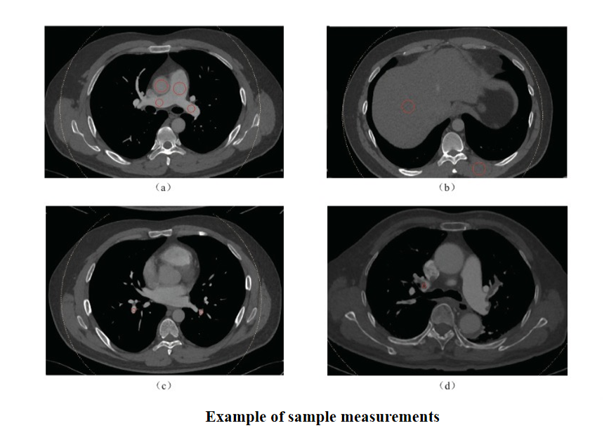 CT2023journal's tweet photo. Setting CT scans to 50 keV makes lung blood clots far more visible than standard imaging. This simple adjustment boosts radiological technologists' confidence in detecting pulmonary embolism, enabling faster alerts and quicker life-saving treatment.😀
https://t.co/8adTrJxFkF https://t.co/tWNV4e566V