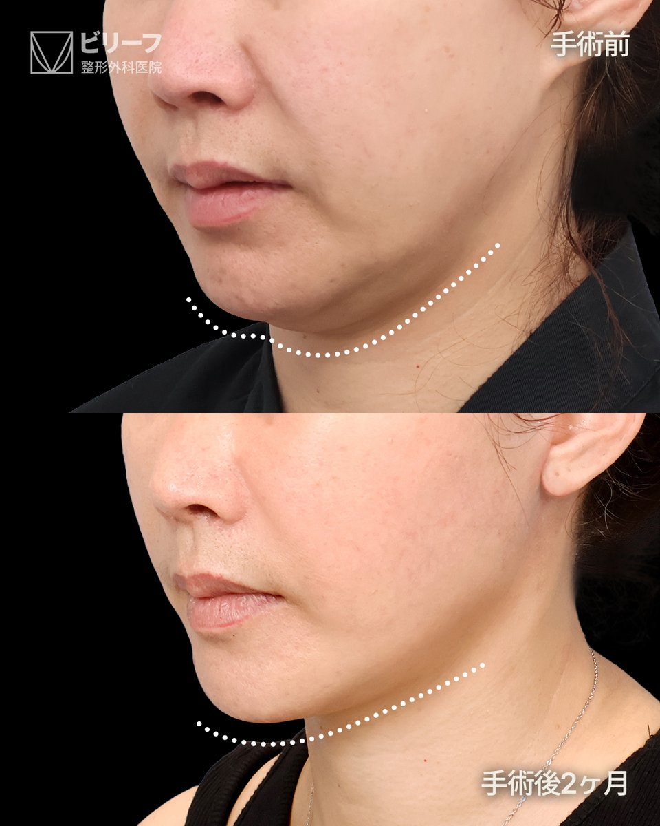 ✨韓国フェイスリフト専門ビリーフ美容外科✨ tweet media