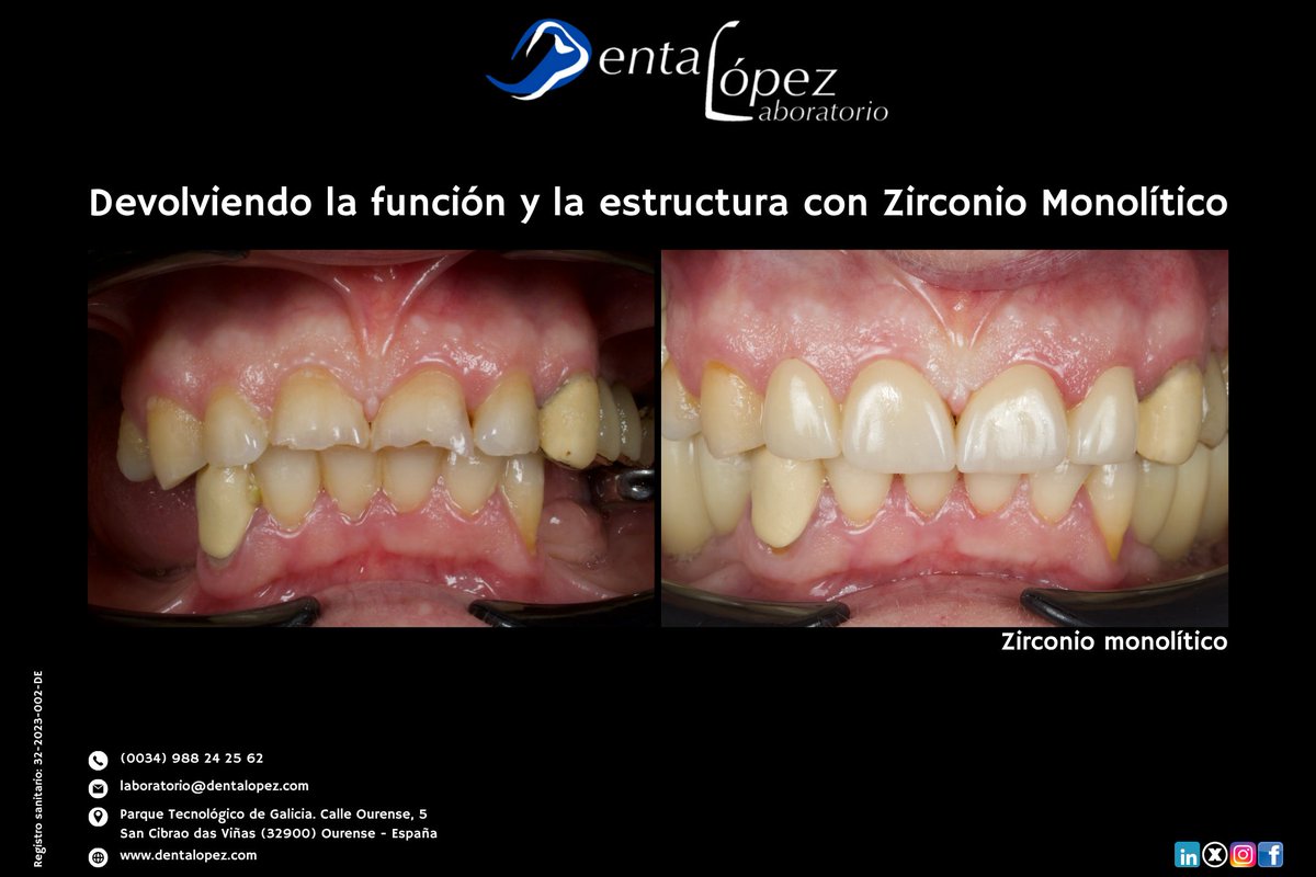 DentaLopez's tweet image. Restauración intraoral: antes y después con retractor. Coronación de piezas con zirconio monolítico. Durabilidad y ajuste preciso para devolver la función y la estructura. 🦷🔬 

#DentalLópez #Restauración #ZirconioMonolítico #DentalTwitter #Precisión #Zirconia