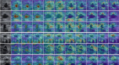 Radiology_AI's tweet image. Clinic-aligned Dual Distillation of Video and Image Foundation Models for Automated Breast Cancer US Diagnosis doi.org/10.1148/ryai.2… @AACR #AACR26 #AACR2026 #cancer #OncoRad #oncology