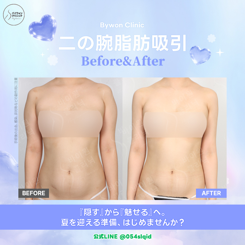 【韓国脂肪吸引専門】バイウォンクリニック tweet media
