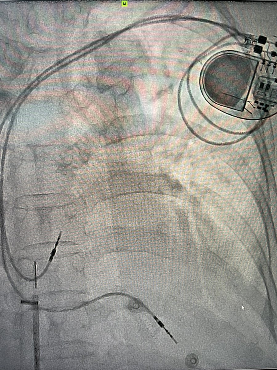 mdjunkim's tweet photo. After extraction and implant new pacer https://t.co/2pfVQD4tjq