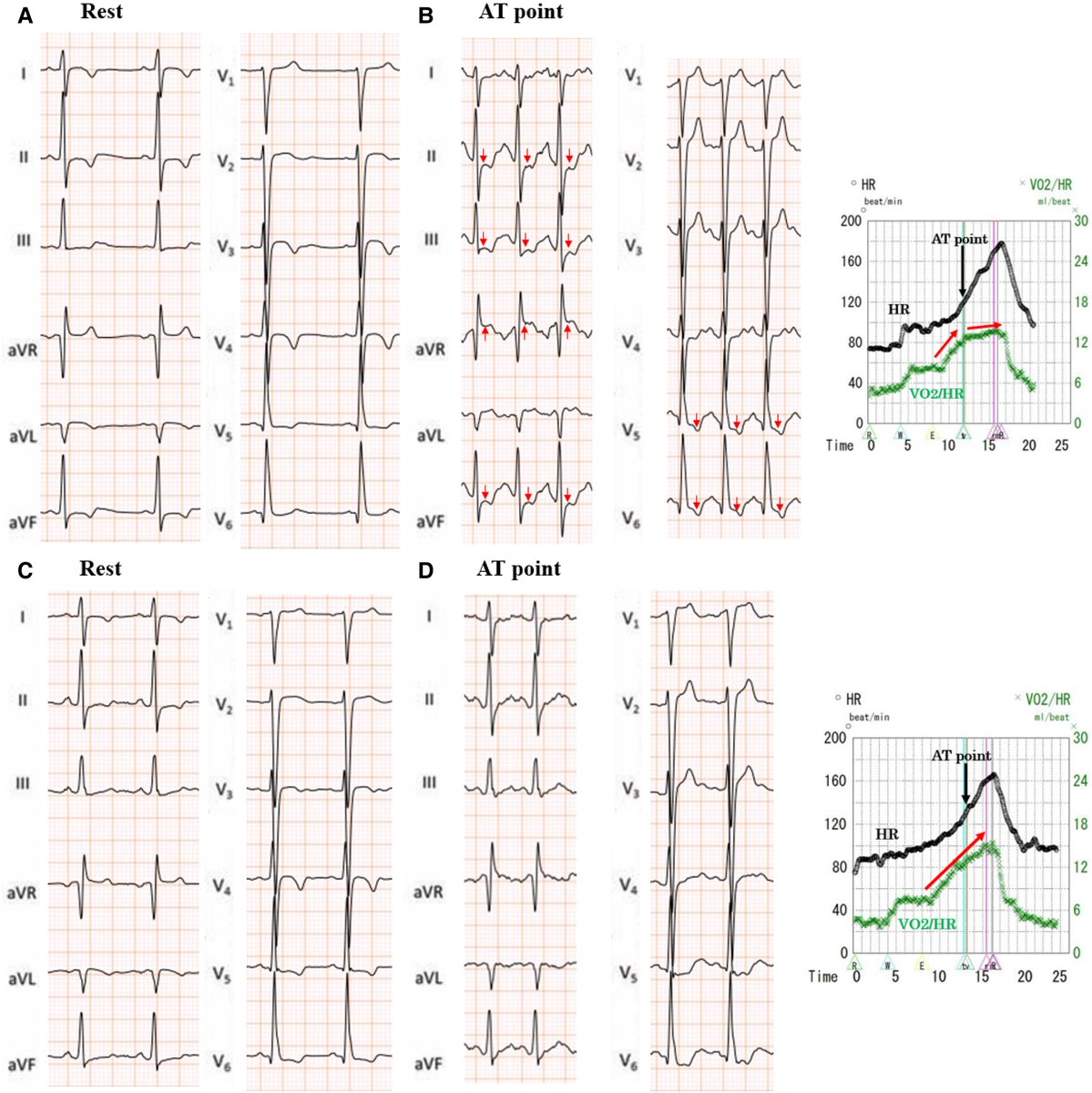 ESC_Journals's tweet image. Utilisation of cardiopulmonary exercise testing to diagnose exercise-induced coronary spasm ow.ly/CP8k50YNk2I

#EHJCaseReports @Phiso_de @TJ_Yeo @aayshacader @BoldiKovacsMD @SukritiBanthiya @ANazmiCalik @O_Azizy_MD @saramoscatelli7 @EHJCREiC #CardioX