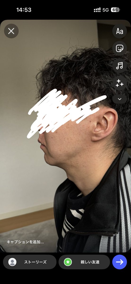 biyoumen8080's tweet photo. アイルミ美容外科でペリカン手術してから約一ヶ月経過。
インディバ1回行ったら拘縮が強いとの事で回数券購入！ペリカンをどれだけやるかによって拘縮の強さも変わってくるとの事。
フルセットで受けたから強いんだろうな。2ヶ月、3ヶ月のアフターで大分引くといいな！ https://t.co/bmXTkgqzF7
