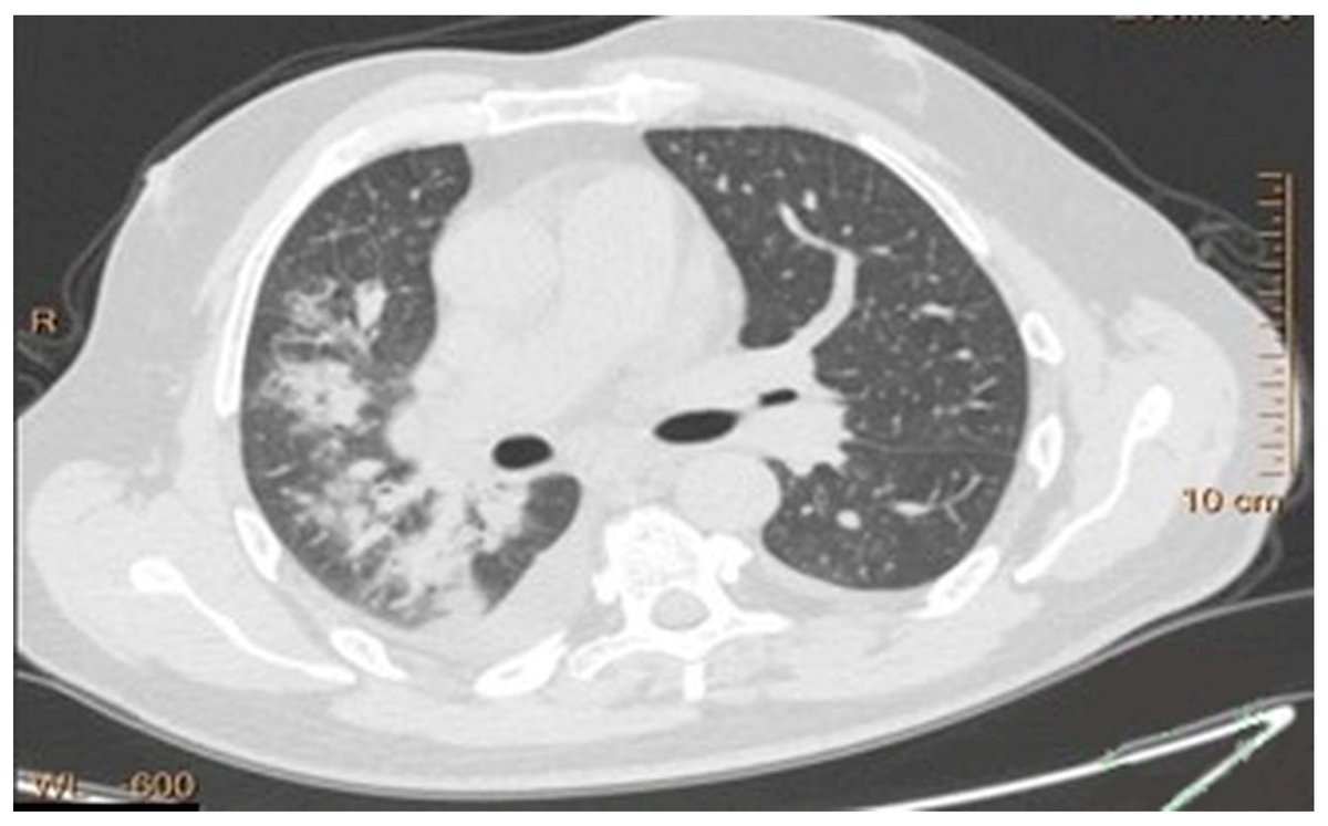 Biomim_MDPI's tweet image. 🫁🤖This study introduces IGSM-enhanced segmentation:
🧠 Brain-inspired feature grouping &amp;amp; channel shuffling
🎯 Better detection of subtle lung nodules
📊 Dice: 0.9665 | Accuracy: 0.9873
💡 A more robust tool for automated CT analysis
mdpi.com/2313-7673/11/2…
#MedicalImaging