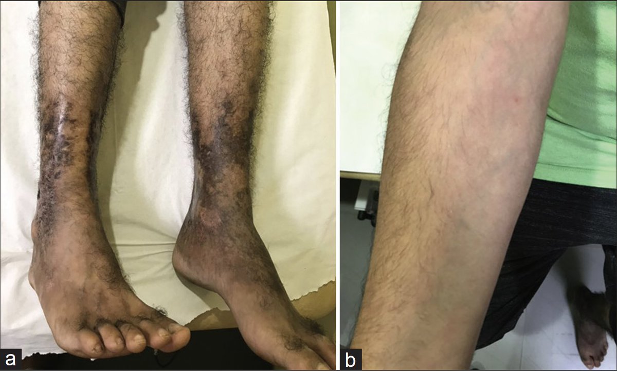 AnnIndAcadNeur's tweet image. Maramattom et al highlight DADA2 mutations as a rare cause of stroke in young. Can cause both ischemic &amp;amp; hemorrhagic stroke and should be strongly suspected in the presence of livedo racemosa. TNF alpha inhibitors are the drug of choice. Link: 10.4103/aian.AIAN_716_20 @neuro_ian