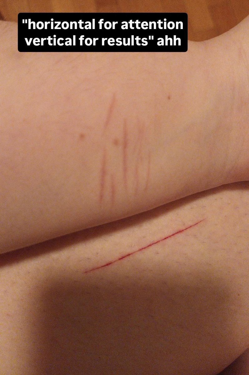 mazum4zu's tweet photo. relapsed last month after 3 years and 2 months but idc cause i aint counting that LOL🔥🥀 but my scars look pretty lowk:3 https://t.co/xuXTXW36kW
