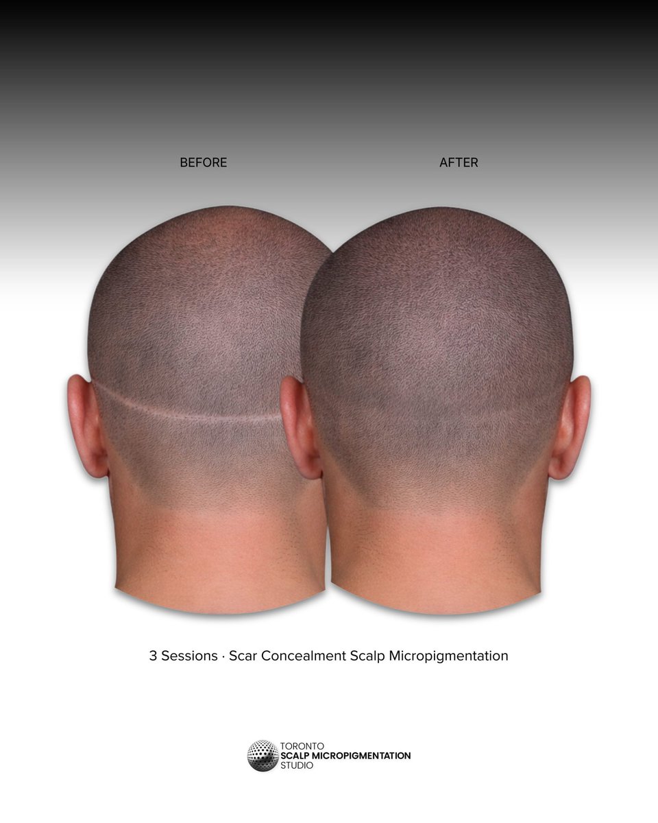 torontosmp's tweet photo. You’re not seeing a treatment. You’re seeing confidence restored. Scalp micropigmentation that brings back the look of real hair—subtle, natural, and built to last for clients in downtown Toronto and the GTA. Book your free, online consultation at the link in our bio #TorontoSMP https://t.co/F1QFghgP7Y