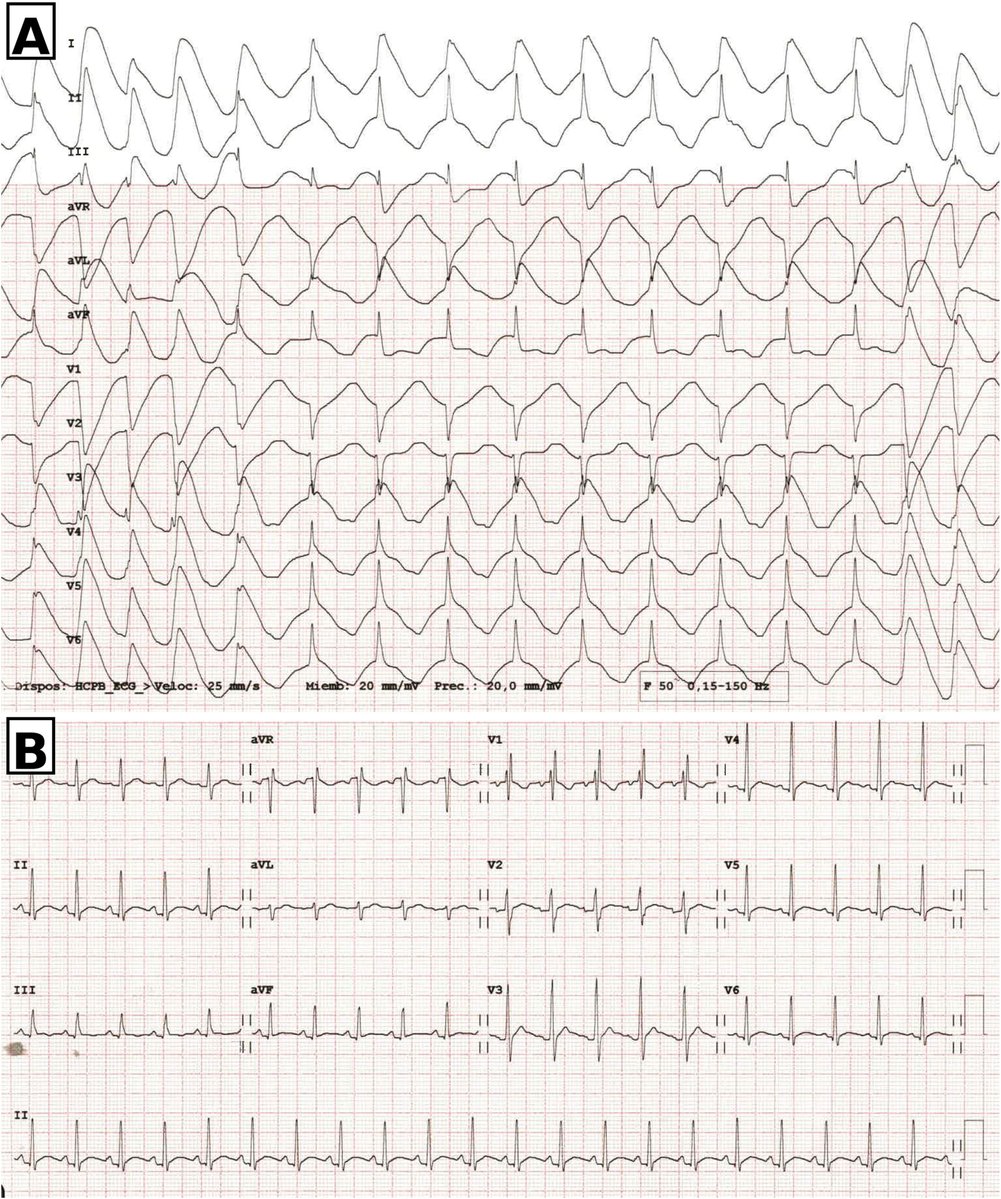 RevEspCardiol's tweet image. Signo del casco prusiano en el electrocardiograma como un indicador crítico #REC @guillemuuus @morenojmm7 @randreariba_rut  revespcardiol.org/es-signo-del-c…
