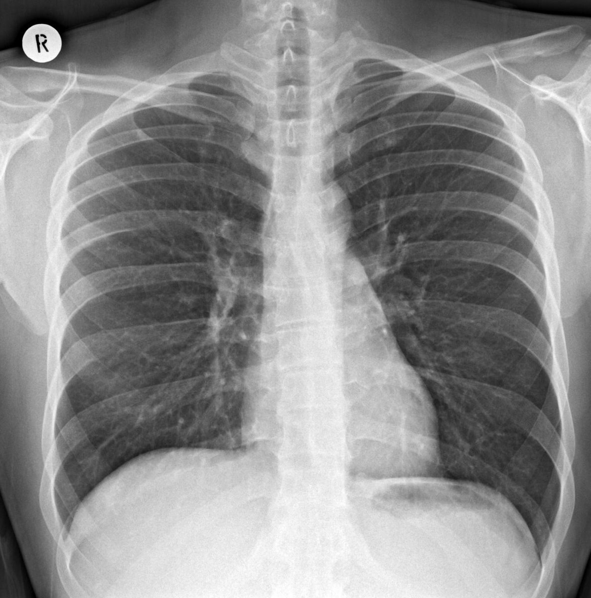 EuroRespSoc's tweet image. Test your knowledge with this week's #radiology image challenge!

Case: 40-year-old male with productive cough and breathlessness

1. What is the main abnormality?

Select your answers: bit.ly/422cxHJ