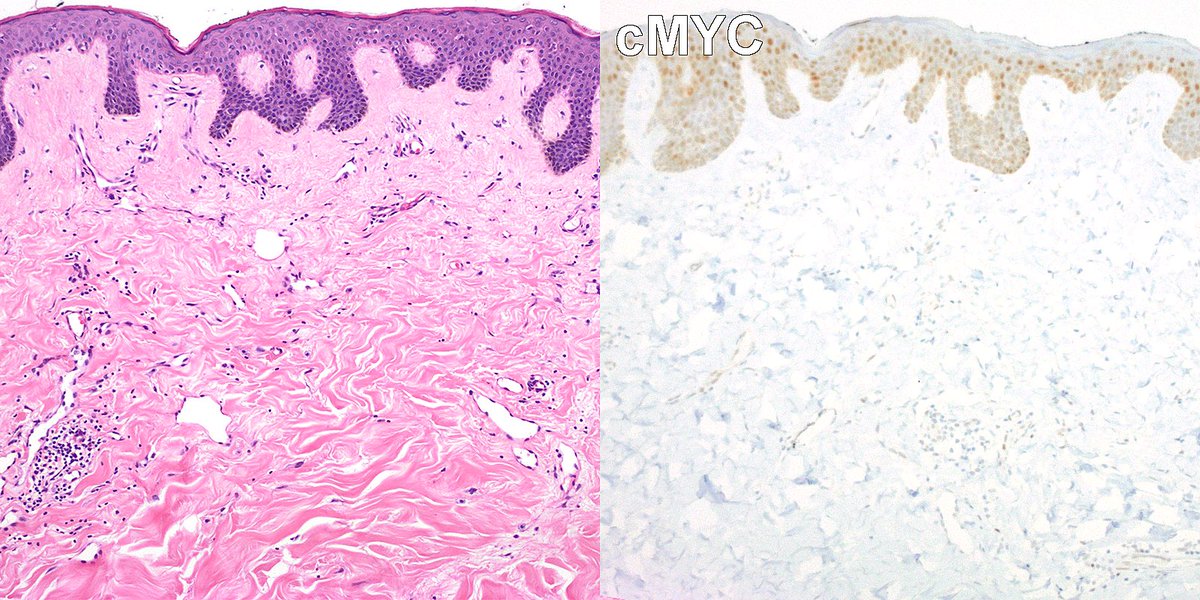RazaHoda's tweet image. Case of Atypical Vascular Lesion 🩸🔬

A superficial radiation-associated vascular proliferation of irregular channels with mild cytologic atypia—lacking the infiltrative growth, multilayering, and cMYC amplification (👇) seen in angiosarcoma.

#PathX #PathTwitter #breastpath