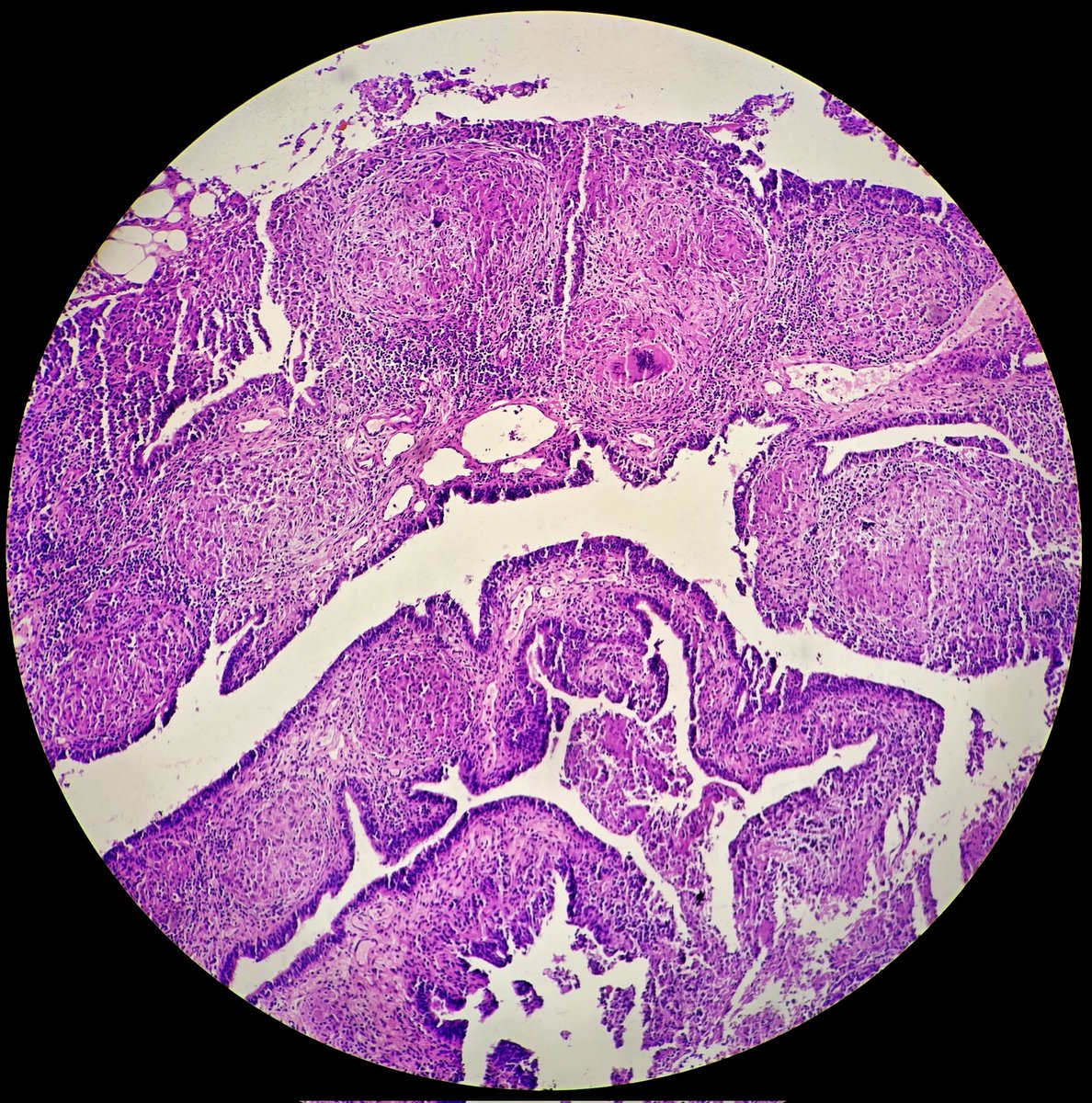 SyedSal55391459's tweet photo. #histopathology
#fallopian tube
#pathX
#pathTwitter
Dx: Tuberculosis. https://t.co/wogCRepvSb