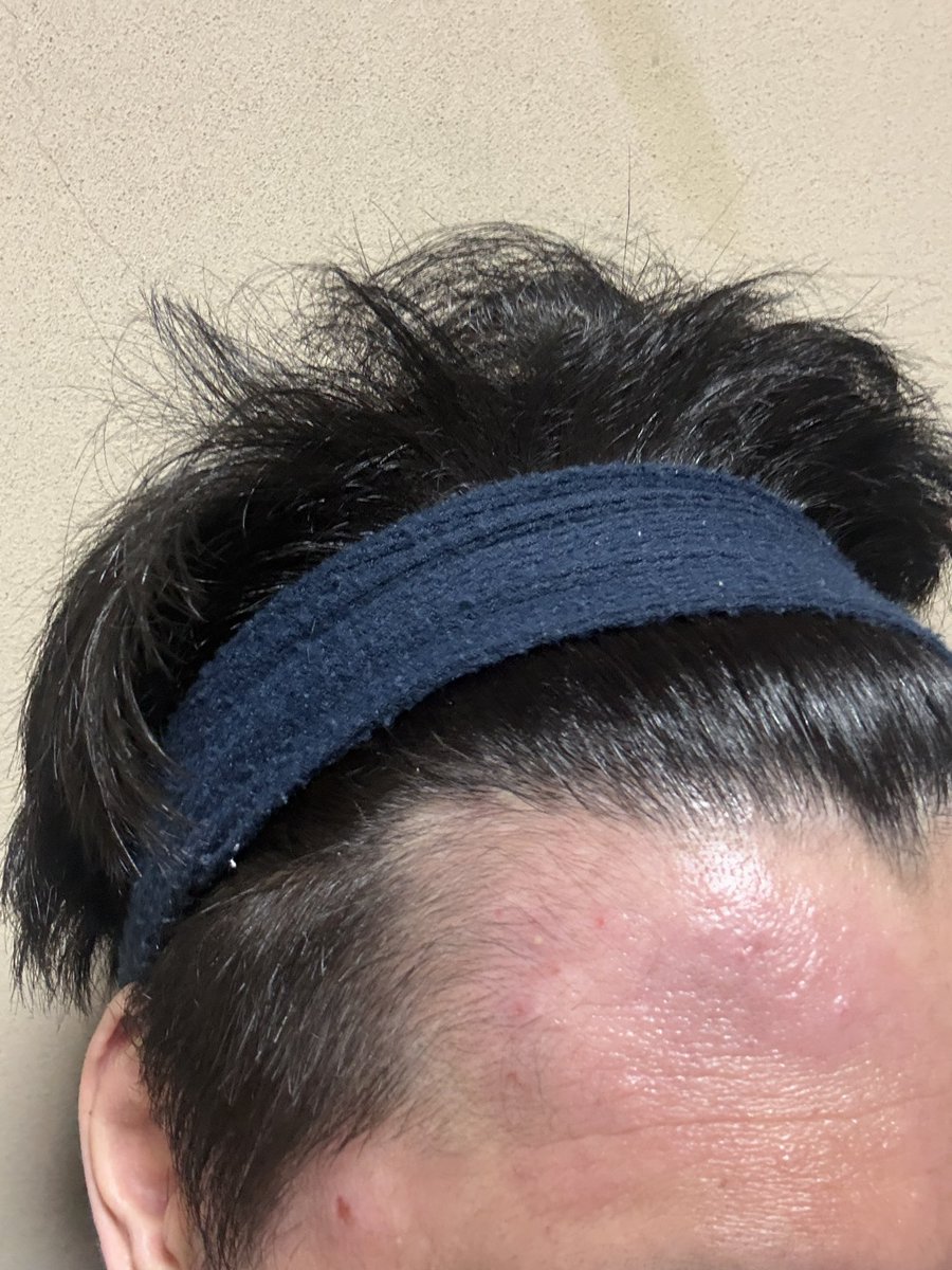 shokumo_journey's tweet photo. 【術後51週目】
お久しぶりです
来週で術後1年です✨ https://t.co/P0CMBrXcOJ