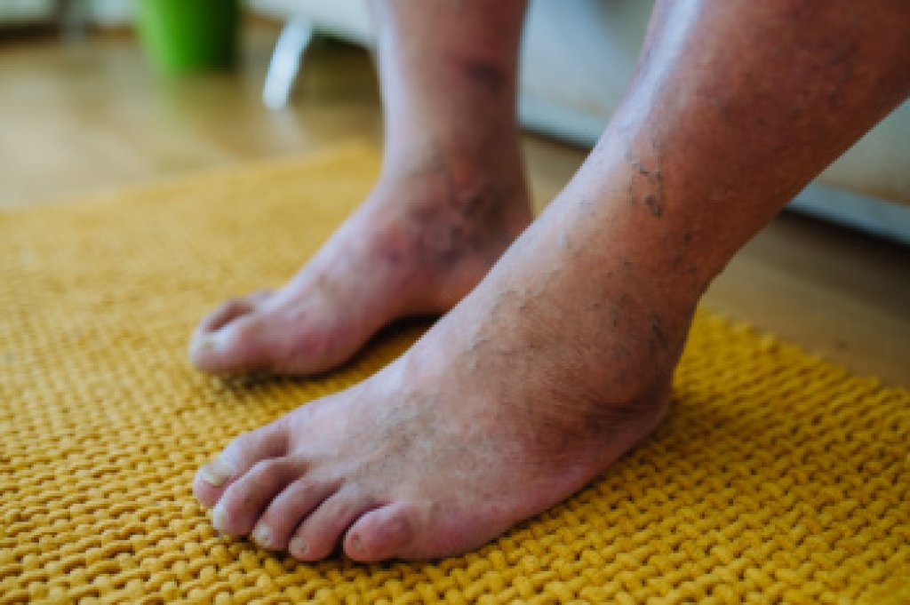 DrLapoff's tweet photo. Protecting Your Diabetic Feet https://t.co/Xf3WsLfaKy https://t.co/k0TIcNbRTc