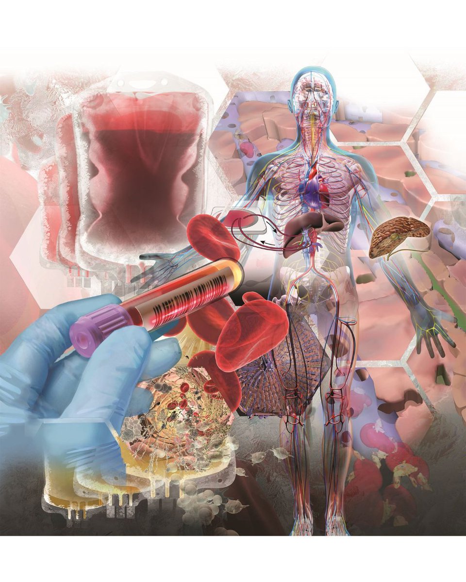 Medillustrates's tweet image. Precision meets complexity in “Liver Transfusion” by @lindasnye. This 3D illustration explores the challenges of blood product management in liver transplantation.

Explore more: medillsb.com/artist.aspx?AI… 

#medicalillustration #3dvisualization #scientificillustration