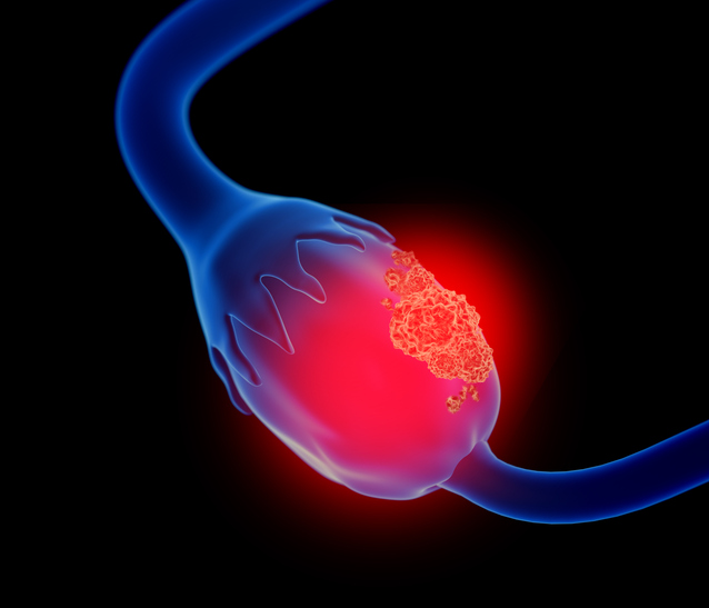 ASCOPost's tweet image. 🚺 New signal in platinum-resistant #ovariancancer 

Investigational ADC QLS5132 showed:
☑️ 50% response rate
☑️ 94% disease control rate
☑️ Manageable safety 

🗣️ Presented by Tao Zhu, MD of Zhejiang Cancer Hospital at #AACR26  

🔗 ascopost.com/news/april-202…