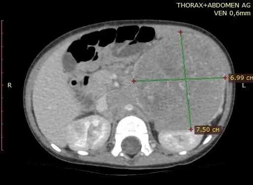 elsa_borisova's tweet photo. 10-month-old girl. 
Massive retroperitoneal mass. 🧵
A classic small round blue cell tumor scenario, but with a cytomorphology twist that can burn you in pediatric cytopathology. Any thoughts?
#cytopathology https://t.co/kopCUJHk7W