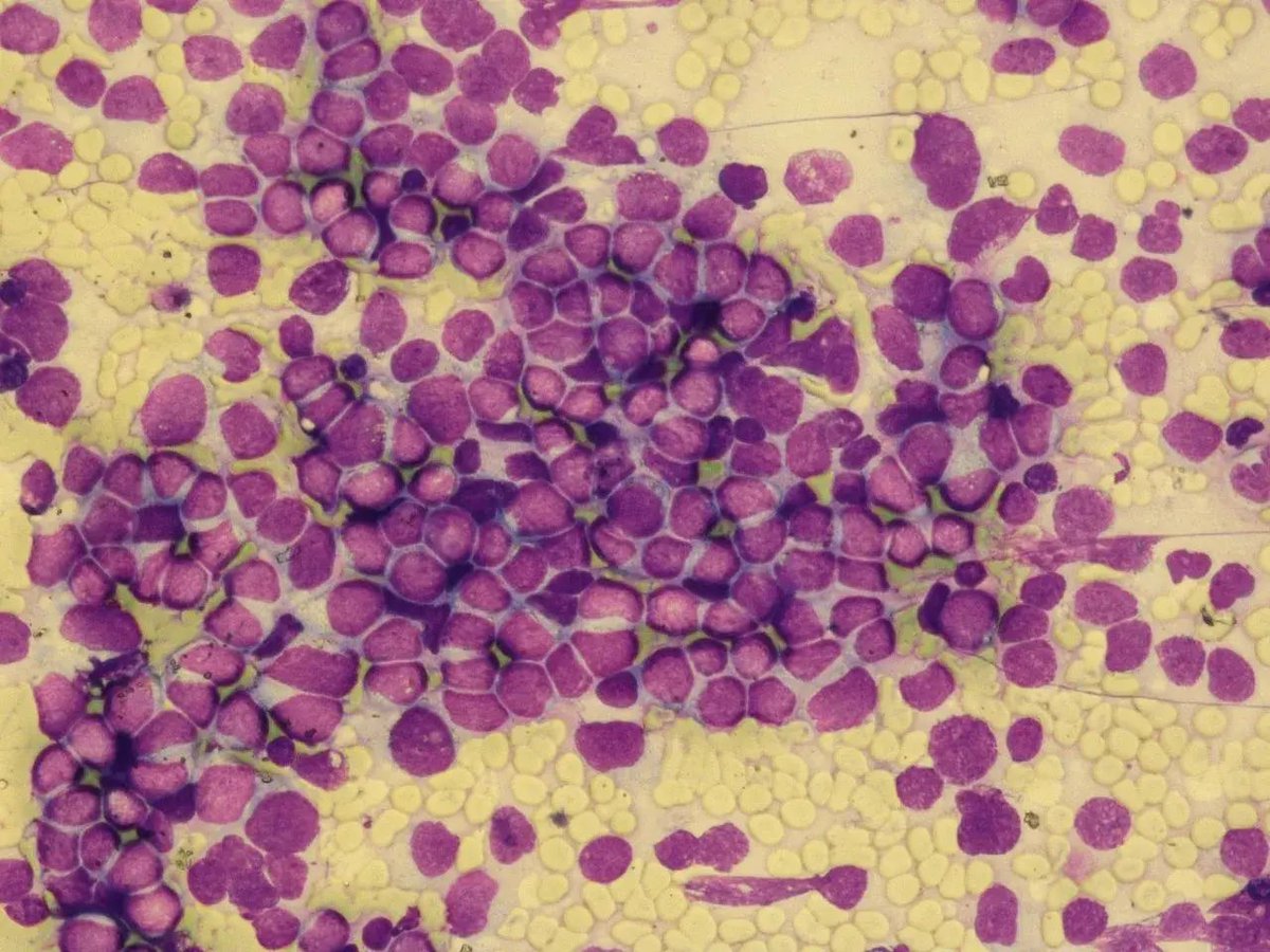 elsa_borisova's tweet photo. 10-month-old girl. 
Massive retroperitoneal mass. 🧵
A classic small round blue cell tumor scenario, but with a cytomorphology twist that can burn you in pediatric cytopathology. Any thoughts?
#cytopathology https://t.co/kopCUJHk7W