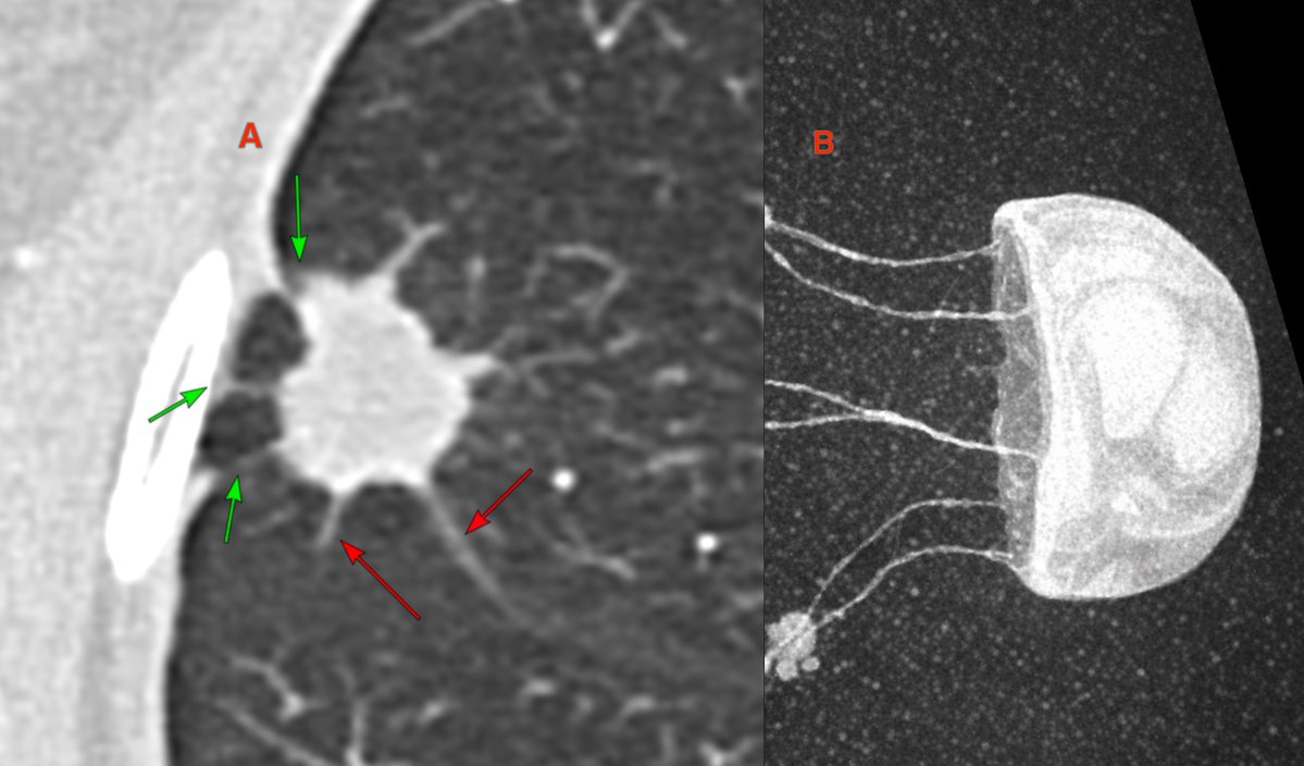 bhavinj's tweet image. Jellyfish sign 🪼
44M. 15 mm RML nodule. Biopsy → adenocarcinoma.
3 tags to costal pleura (green) + more tags to major fissure (red).
Tags to &amp;gt;1 pleural surface = visceral pleural invasion until proven otherwise.
Full case: ctchestreview.com/post06/
#ctchest #lungcancer