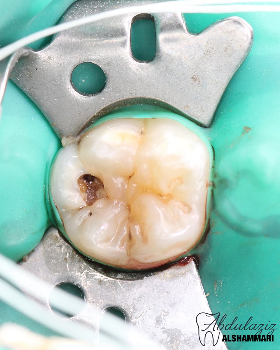 dent_aziz's tweet image. Class I restoration for lower molar 🪄
حشوة ضوئية لترميم الضرس المتسوس 

#dentist #restoration #طب #تجميل #حشوات #dentistry