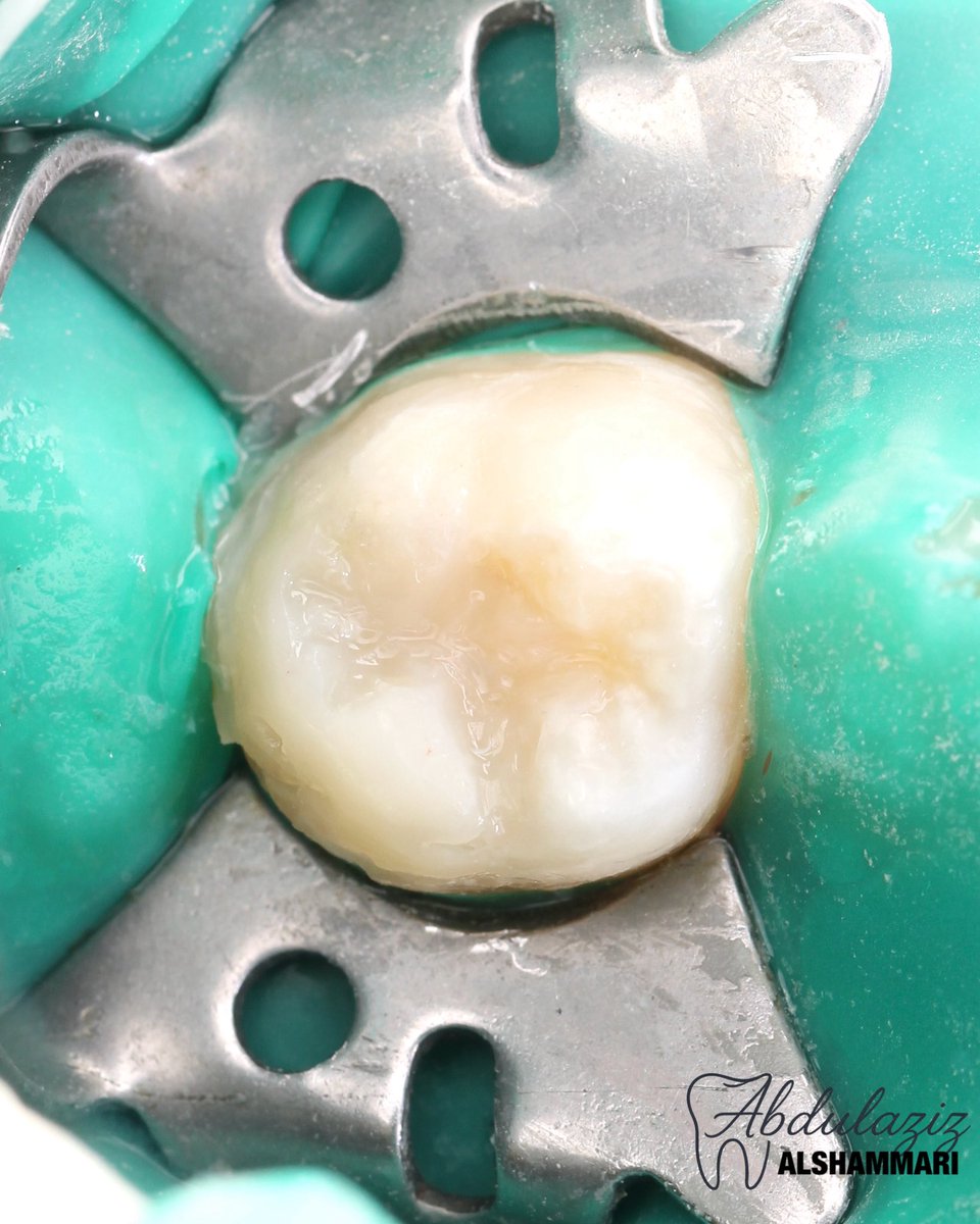dent_aziz's tweet image. Class I restoration for lower molar 🪄
حشوة ضوئية لترميم الضرس المتسوس 

#dentist #restoration #طب #تجميل #حشوات #dentistry