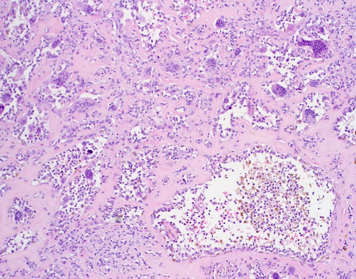 JMGardnerMD's tweet image. Can you make a diagnosis from one pic, or is it #TooCloseToDiagnose? 
More pics: kikoxp.com/posts/15384 
Answer ✅ youtube.com/watch?v=K3KCK4…
#pathology #pathologists #pathTwitter #dermpath #dermatology #dermatologia #dermtwitter #BSTpath