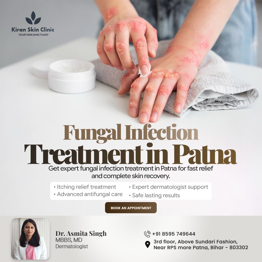 kiranskinpatna's tweet image. Suffering from a fungal skin infection? 😟

✅ Itching Relief Treatment
✅ Advanced Antifungal Care
✅ Safe &amp;amp; Lasting Results

Dr. Asmita Singh | MBBS, MD
📍 Patna | 📞 +91 8595 749644

Book at Kiran Skin Clinic! 🌿

#FungalInfection #SkinCare #Patna