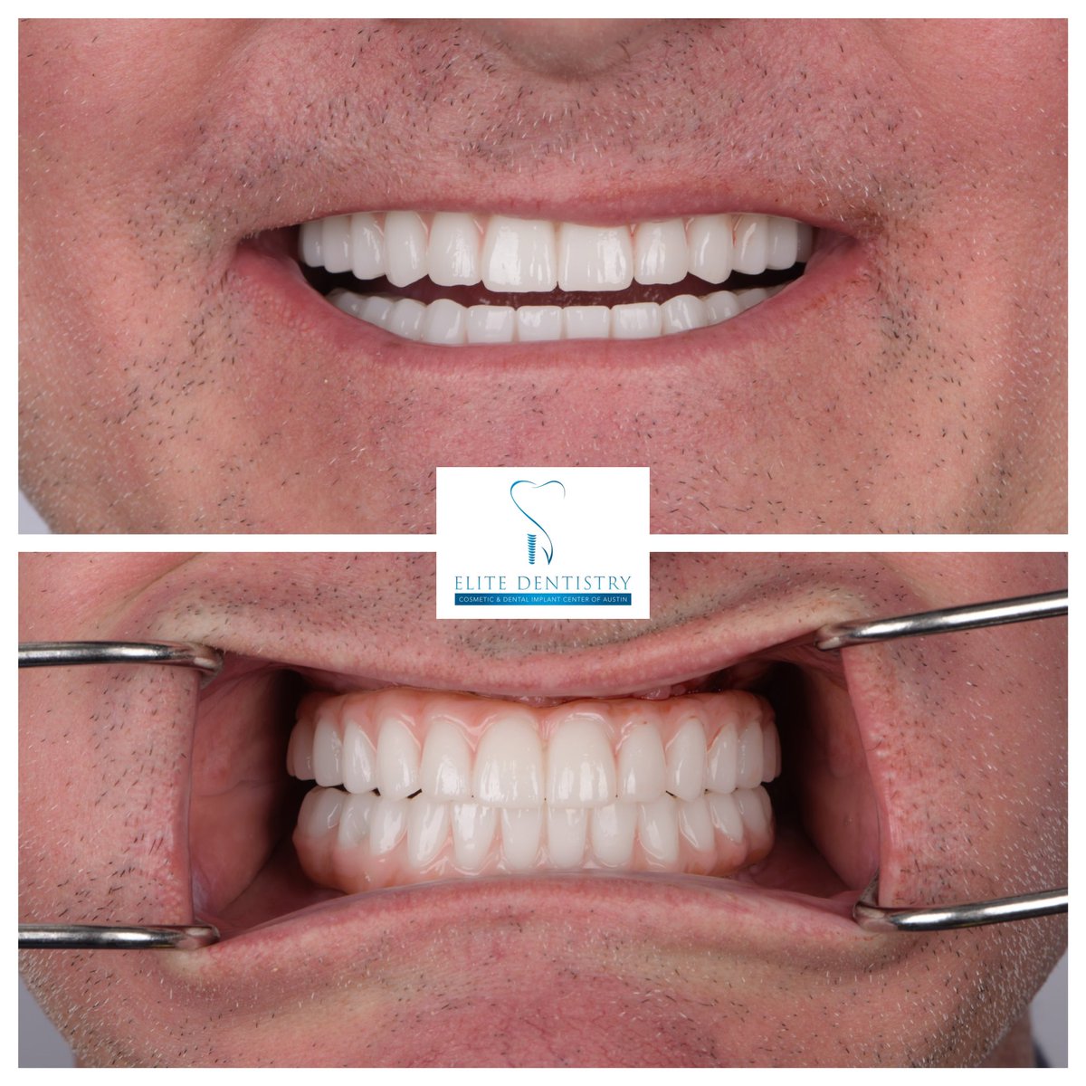 elitedentistatx's tweet image. Thinking about a smile makeover in Austin, Texas? 👀🦷✨

At Elite Dentistry, we design smiles that look natural, feel comfortable, and last. 💙

From your first consultation to your final results — we guide you every step of the way.

📍 Elite Dentistry — Austin

#dental