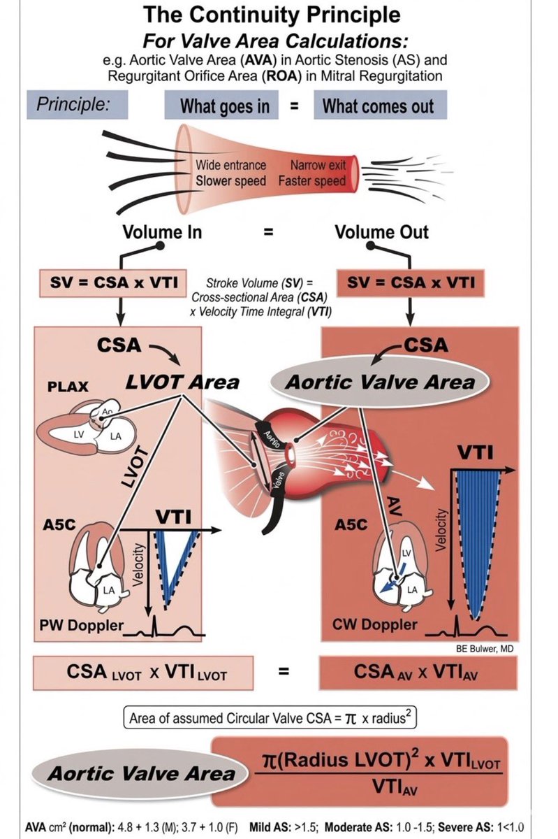 ZainKhalpey's tweet image. Echo uses LVOT measurements and Doppler velocities together to estimate aortic valve area. 

Simple concept, practical application. 

Belwer, MD

#Cardiology #Echocardiography #AorticStenosis #MedTwitter