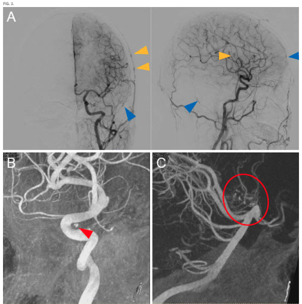 Journal of Neurosurgery tweet media